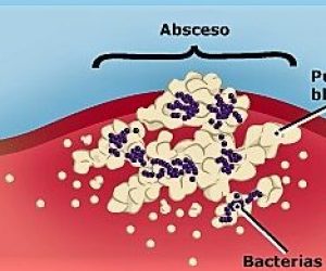 Absceso-copia-390×195 Absceso-copia-390x195