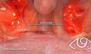 admidalitis-reemp-3